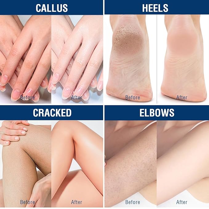 OUKEYA Urea Cream 40 Percent, Foot & Hand Cream for Dry Cracked, Urea Lotion for Feet Maximum Strength(12.35Oz X 4 Packs)