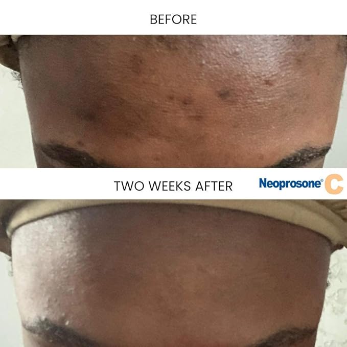 Neoprosone, Vitamin C Serum for Face | 1 Fl oz / 30ml | Brightening Serum For Dark Circle, Wrinkles | with Alpha Arbutin and Castor Oil