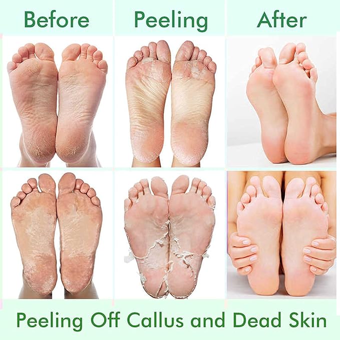 5 Pack Foot Peeling Mask,Exfoliator Peel Off Calluses Dead Skin Callus Remover,Foot Mask for Dry Cracked Feet,Foot Peel Masks for Men and Women Feet Peeling Mask for Stocking Stuffers