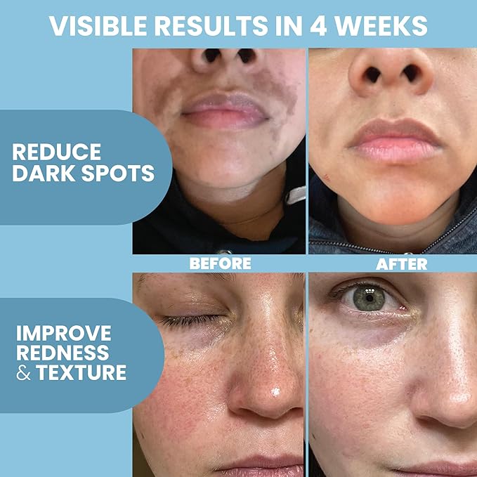 Azelaic Acid 10% Facial Serum – With Niacinamide, Hyaluronic Acid – Lightweight Face Serum – 2 oz