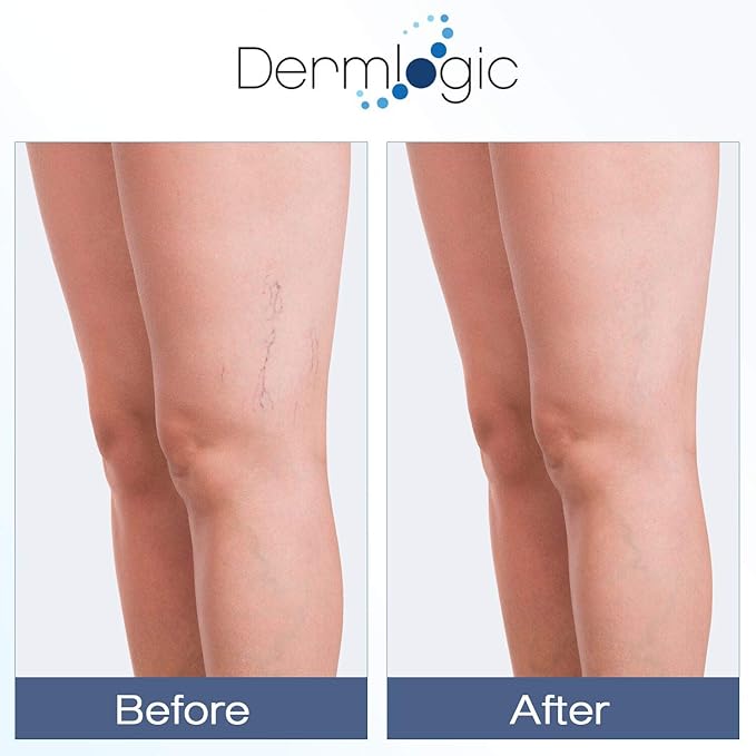 Vitamin K Cream- Moisturizing Bruise Healing Formula. Dark Spot Corrector for Bruising, Spider Veins & Broken Capillaries. Reduces Under Eye Dark Circles, Fine Lines, Puffiness, & Wrinkles with Arnica