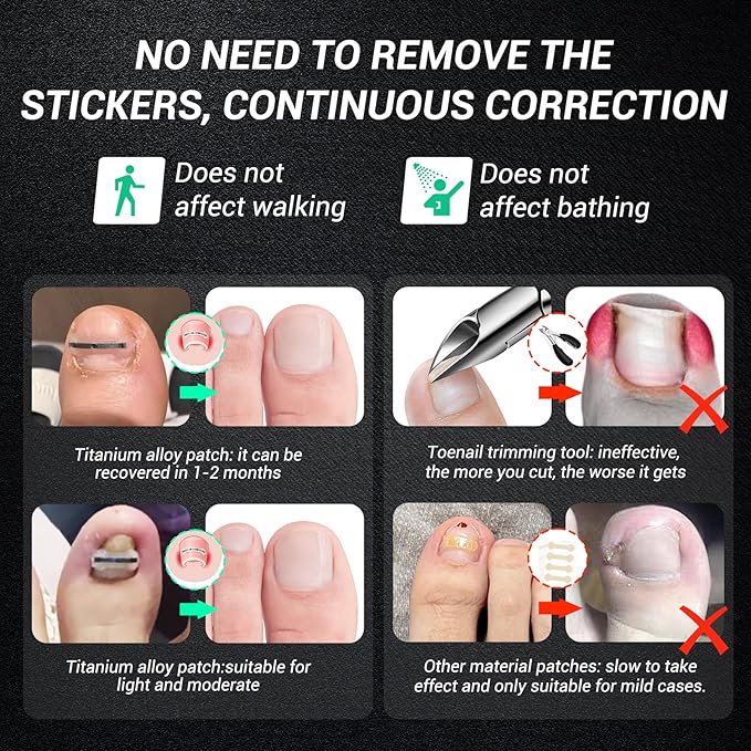 Titanium Alloy Ingrown Toenail Treatment, Nail Tools, and Ingrown Toenail Removal Kit Specially Designed for Curved Nail Repair and Ingrown Toenail Corrector (0.59/0.67in)